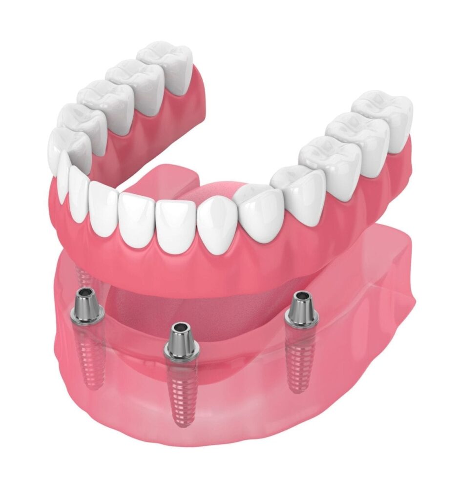 Dentures Attachment System Universal Dentistry
