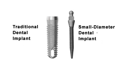 Affordable Small-Diameter Implants in Cherry Hill, NJ - Universal Dentistry